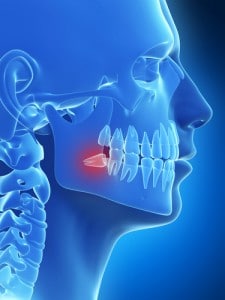 Getting Wise about Wisdom Teeth