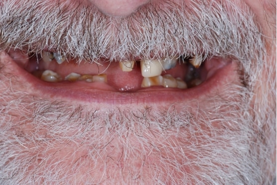 before dental implants in Lakeway, TX
