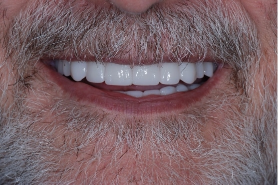 after dental implants in Lakeway, TX