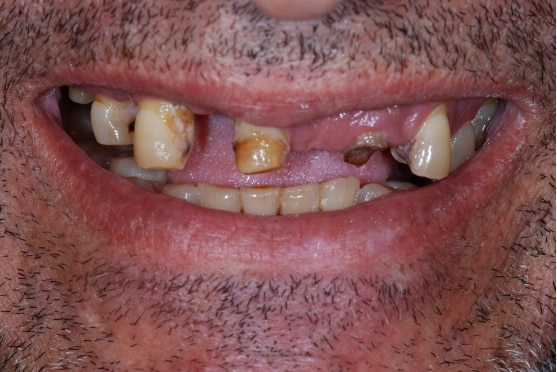 before dental implants in Lakeway, TX