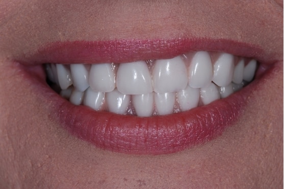 after dental implants in Lakeway, TX