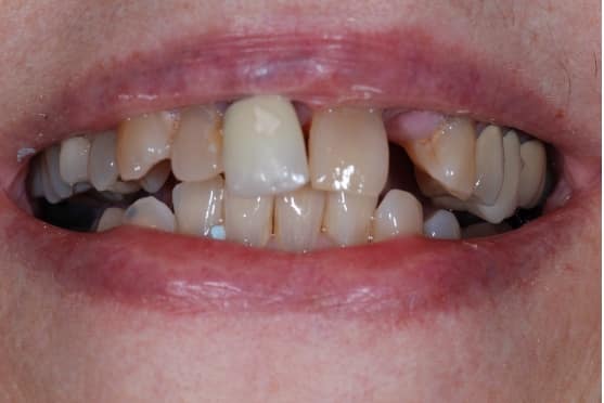 before dental implants in Lakeway, TX