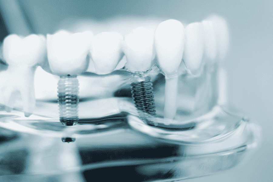 The Cost of Dental Implants In Austin, TX