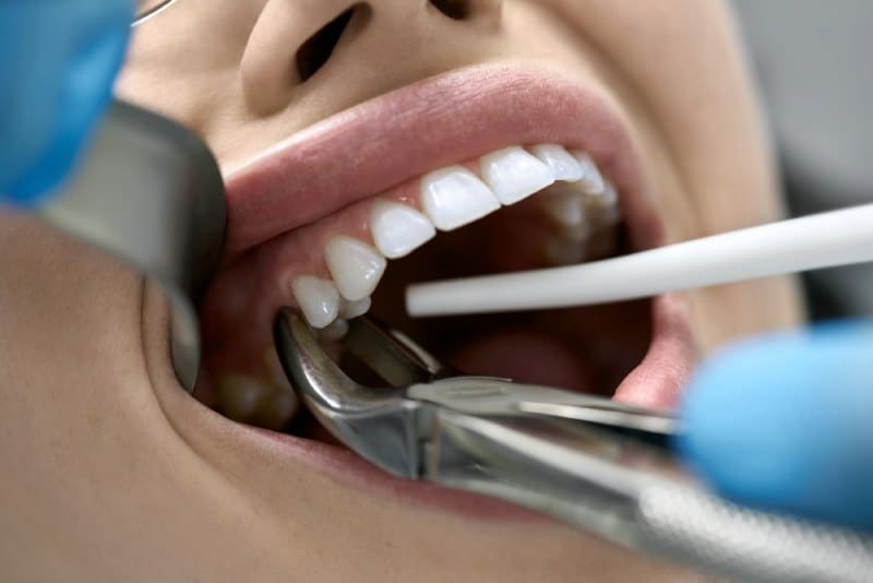 Dentist holds a female patient's mouth open to extract a molar.